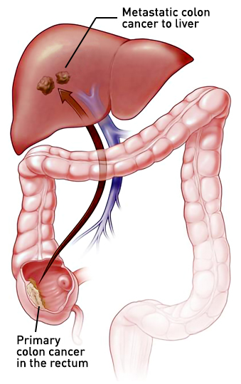 sirtex-liver-metastases